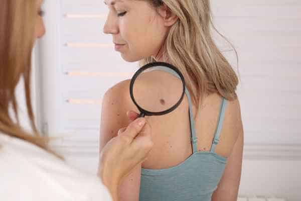 What Are Traditional Skin Lesion Removal Methods Brighton and Hove?