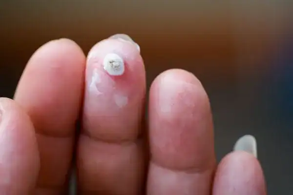Image of white wart before cryopen treatment Brighton and Hove