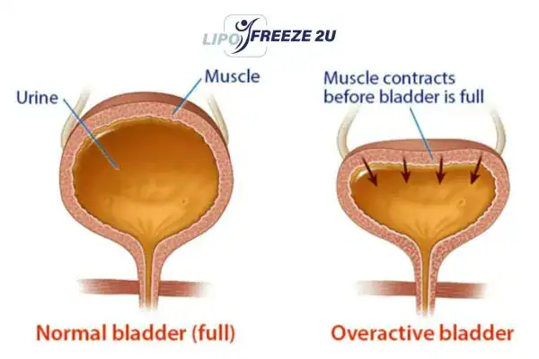 diagram of overactive bladder treatment Brighton and Hove