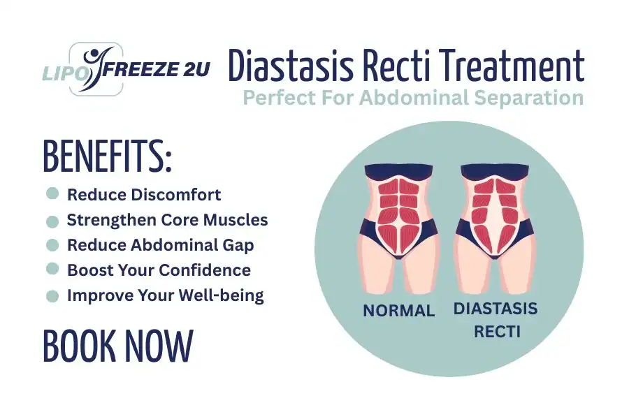 Benefits of body toning treatment Brighton and Hove for Diastasis recti