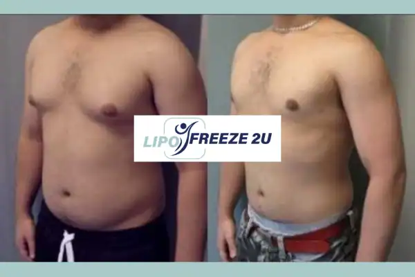 Before and after fat freezing results Brighton and Hove