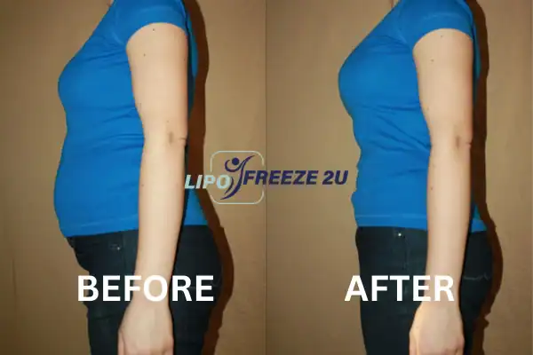 Fat freezing before and after results from Lipo Freeze2U Brighton and Hove