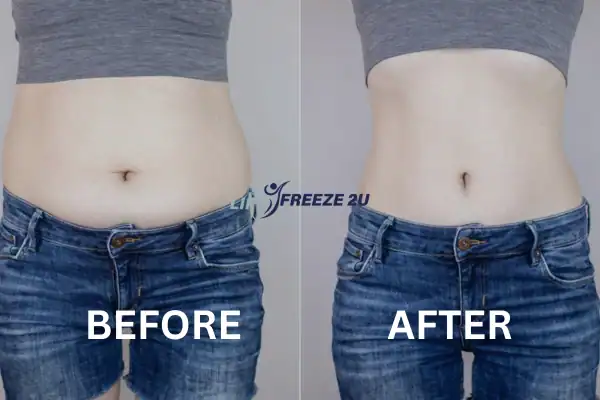 image of womans stomach before and after fat freezing treatment Brighton and Hove Results