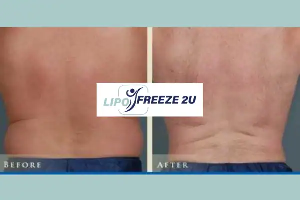 Fat freezing Brighton and Hove before and after results for mans love handles