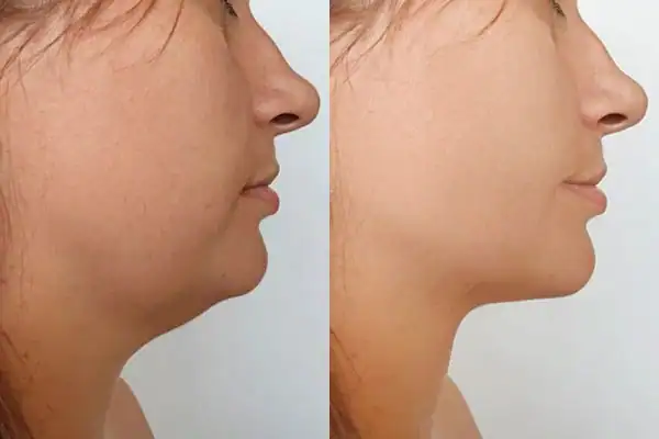 Fat dissolving injections results Brighton and Hove