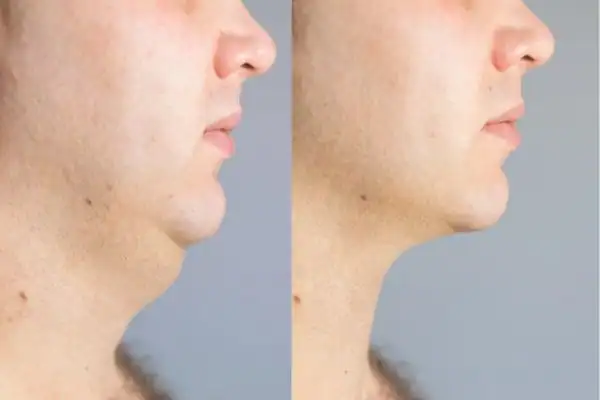 Fat dissolving injections results Brighton and Hove