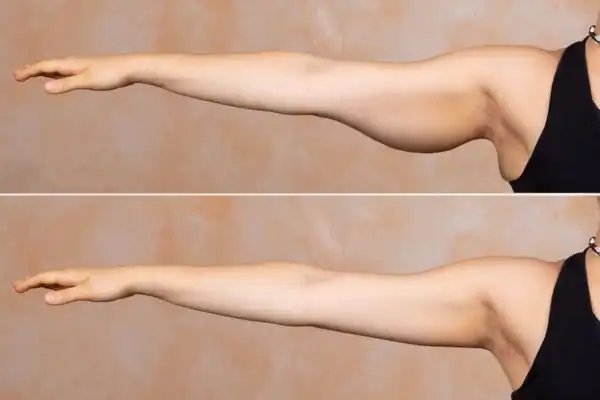 Results on the arms of fat dissolving injections Brighton and Hove