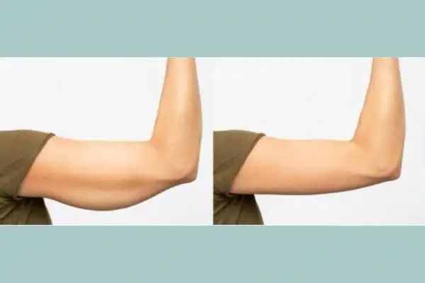 Body toning treatment Brighton and Hove before and after results