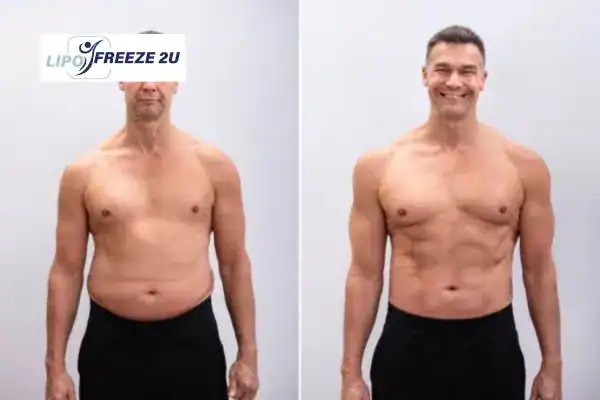 Body toning treatment Brighton and Hove before and after results