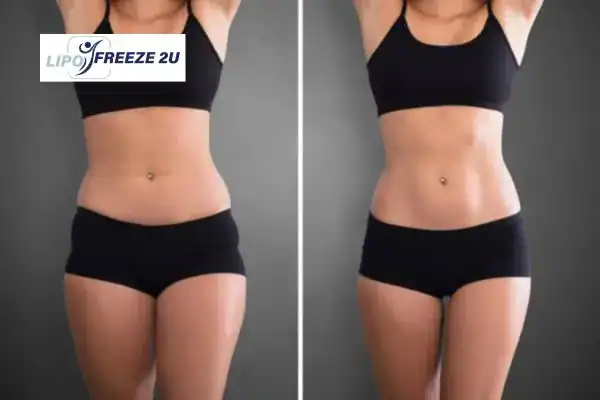 Body toning treatment Brighton and Hove before and after results