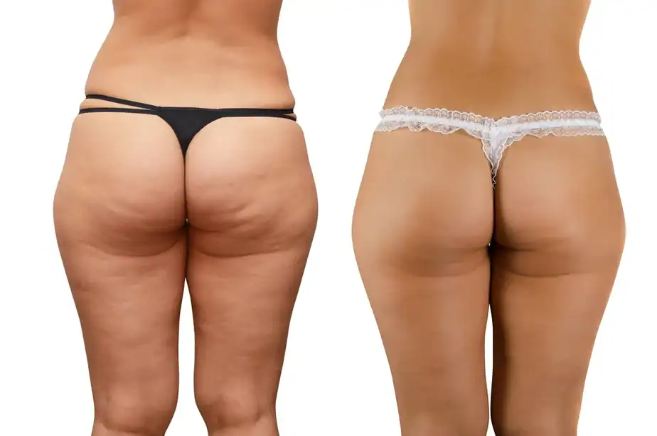 Before and after cellulite treatment Brighton and Hove results.