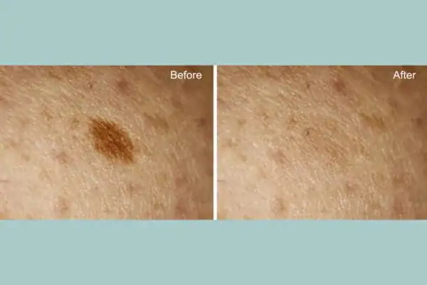 Before and after age spot removal following Cryopen Cryotherapy Treatment Brighton and Hove