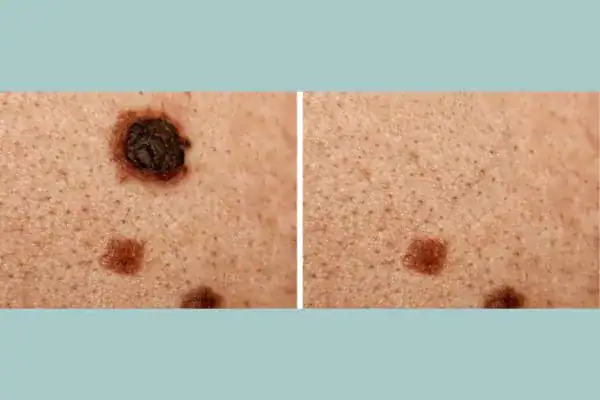 Before and after results from Cryopen Cryotherapy Treatment Brighton and Hove