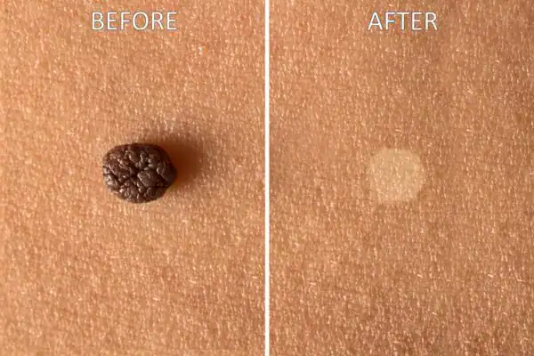 Before and after results of Cryopen Cryotherapy Treatment Brighton and Hove