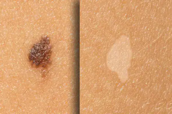 Before and after results Cryopen Cryotherapy Treatment Brighton and Hove