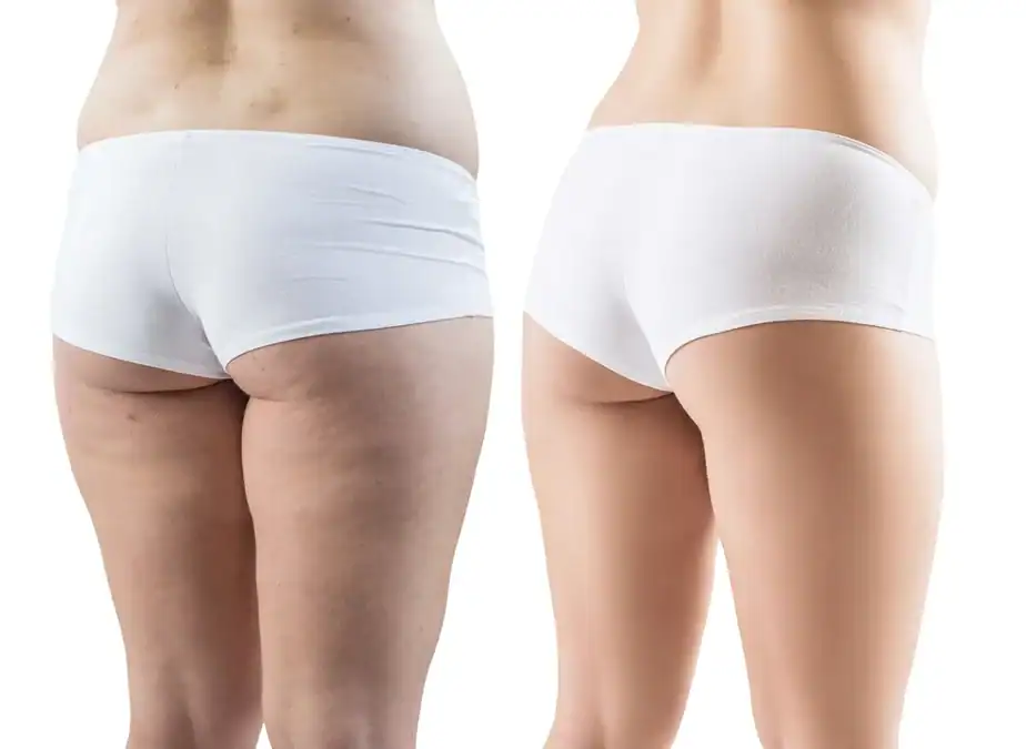before and after Inner thighs toning treatment Brighton and Hove results