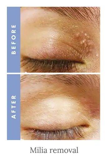 Before and after results of milia removal treatment Brighton and Hove.