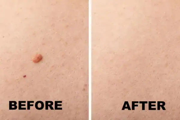before and after mole removal Brighton and Hove results