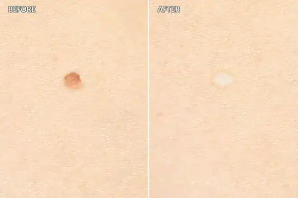mole removal Brighton and Hove before and after results following cryopen treatment