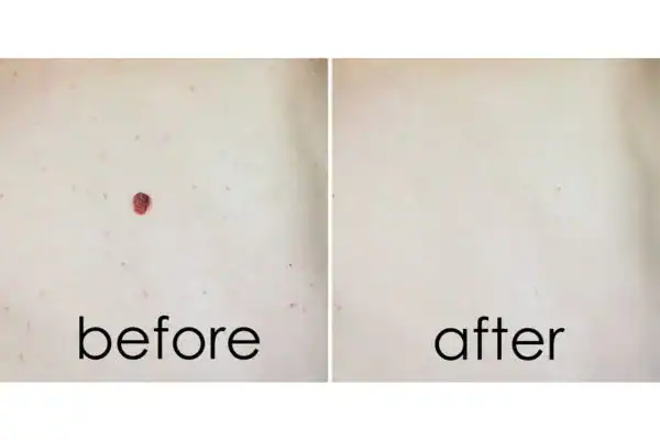 before and after mole removal Brighton and Hove results