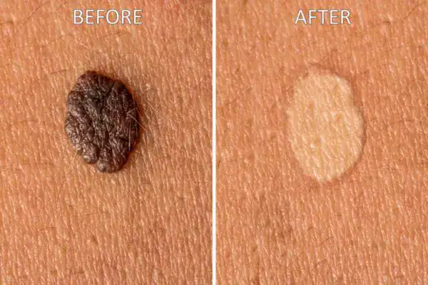 cryopen before and after results for mole removal Brighton and Hove