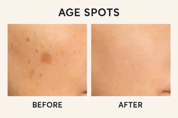 Before and after results of age spots removal Brighton and Hove