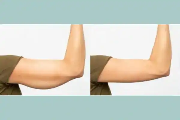 Before and after results of arm toning treatment Brighton and Hove
