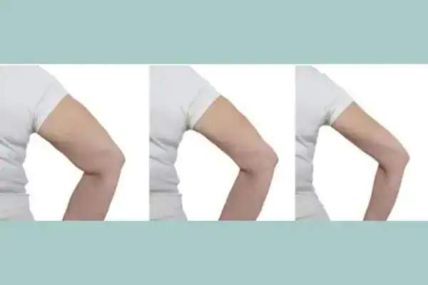 before and after results of arm toning treatment Brighton and Hove