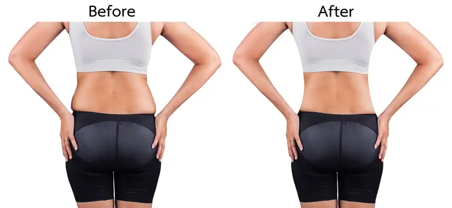 Before & After back toning treatment Brighton and Hove