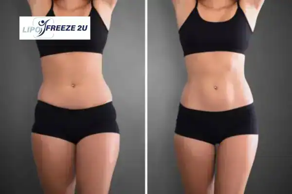 How Can LIPO FREEZE 2U Support Your Post-Pregnancy Body Recovery Brighton and Hove?
