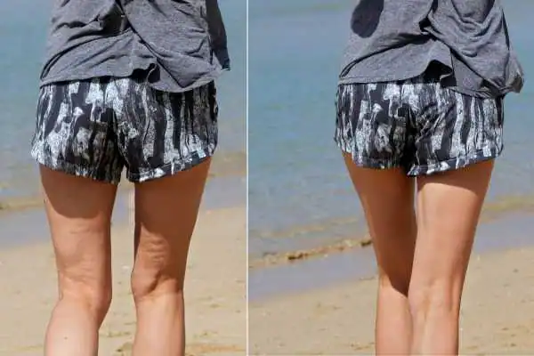 before and after results of cellulite treatment Brighton and Hove