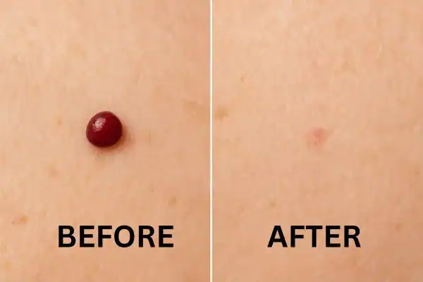 Cherry angioma removal Brighton and Hove before and after results
