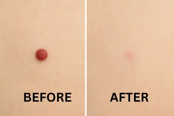 Results of before and after Cherry angioma removal Brighton and Hove