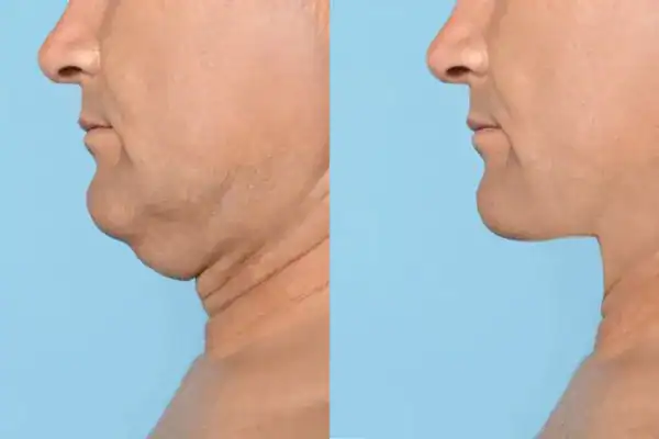 mans before and after chin toning treatment Brighton and Hove results.