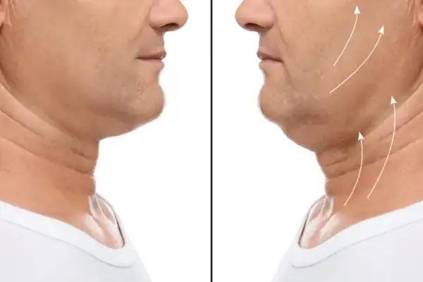 Before and after chin toning treatment Brighton and Hove results.