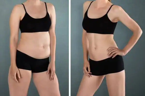 Before and after hip toning treatment Brighton and Hove