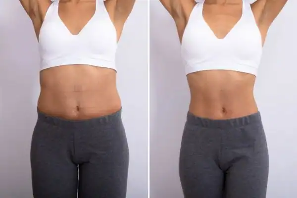 Before and after results of Hip toning treatment Brighton and Hove
