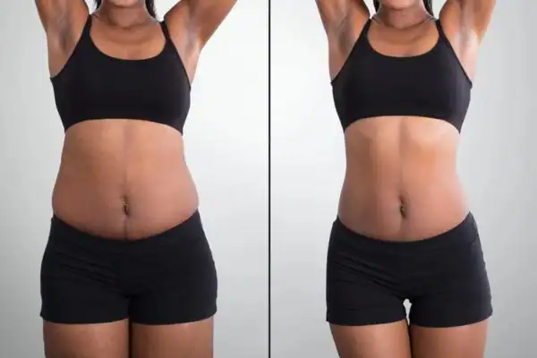 before and after hip toning treatment Brighton and Hove