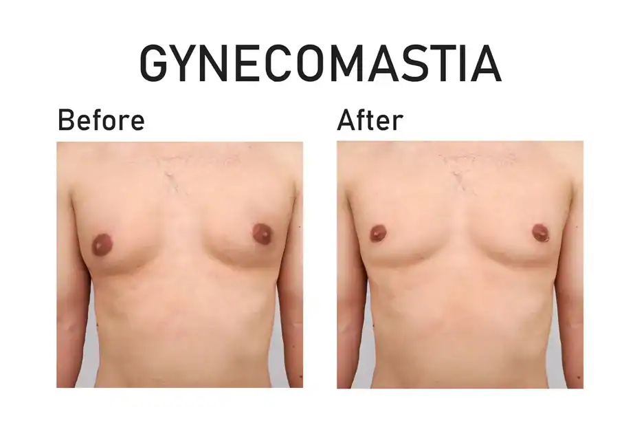 before and after man boobs treatment Brighton and Hove
