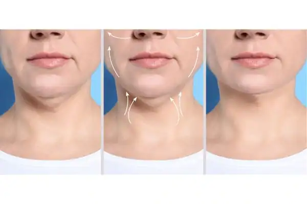 womans result of neck toning treatment Brighton and Hove