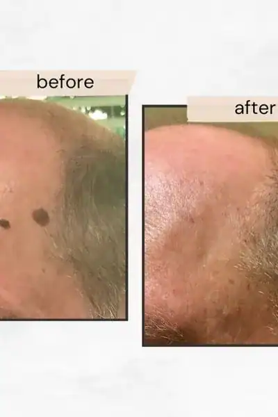 Results of before and after seborrheic keratosis treatment Brighton and Hove