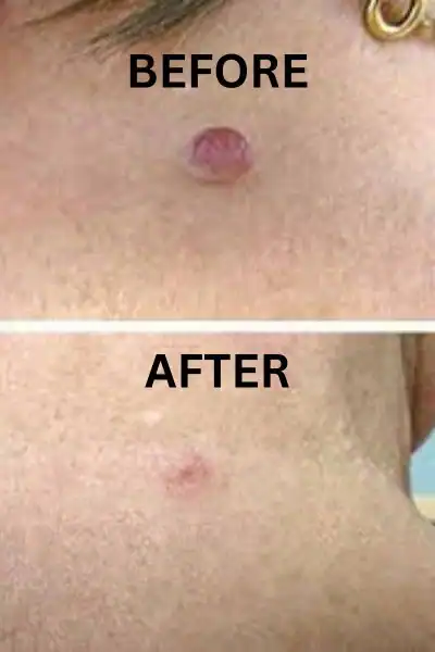 Before and after results of skin tag removal treatment Brighton and Hove