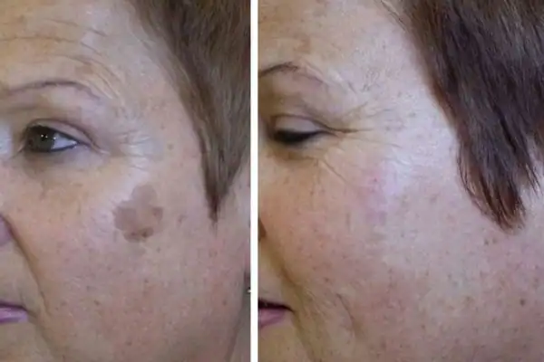 Before and after results of sun damage removal Brighton and Hove