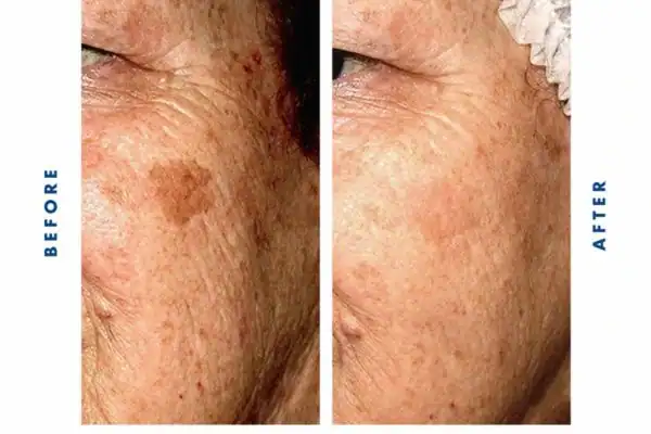 Before and after results of sun damage removal Brighton and Hove
