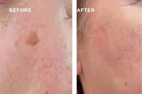 Before and after results of sun damage removal Brighton and Hove