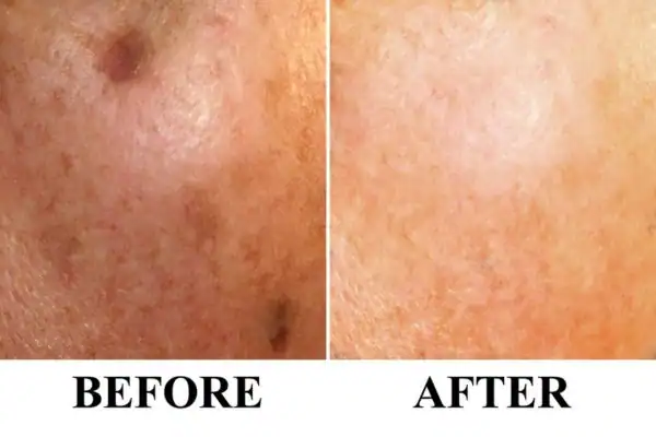 Before and after results of sun damage removal Brighton and Hove