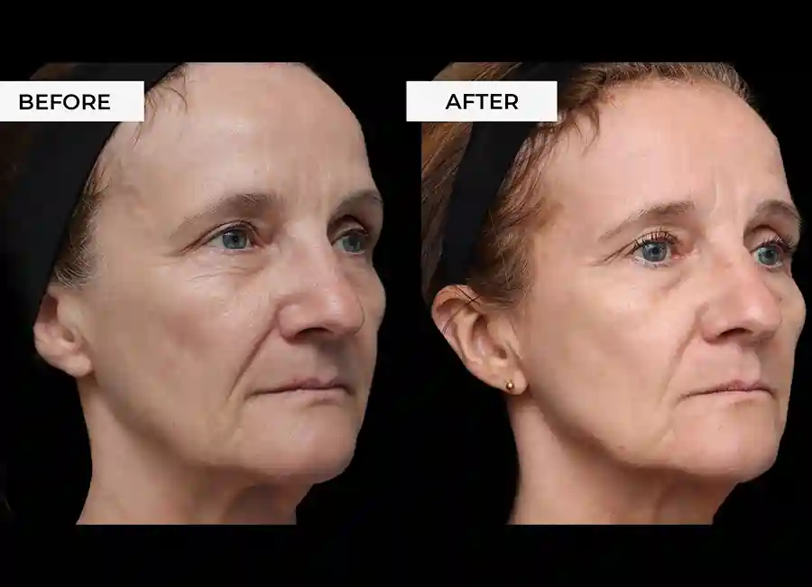 How Many RF Microneedling Sessions Will You Need to See a Difference Brighton and Hove?