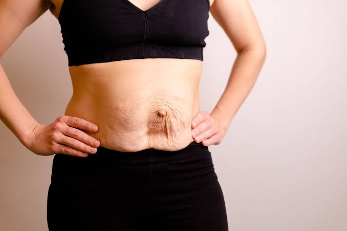 Is Surgery Really the Only Way to Repair Diastasis Recti Brighton and Hove?
