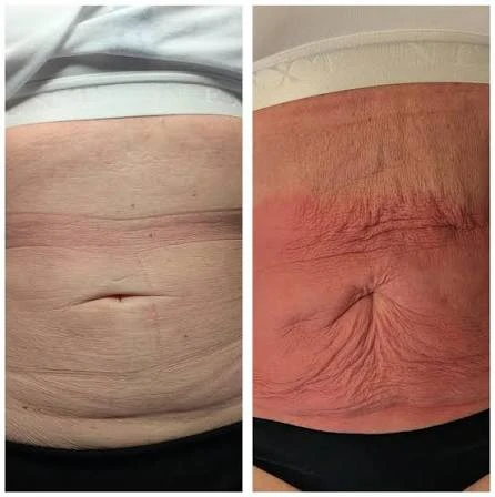 How Does RF Microneedling Improve Crepey, Thin and Uneven Skin Texture Brighton and Hove?