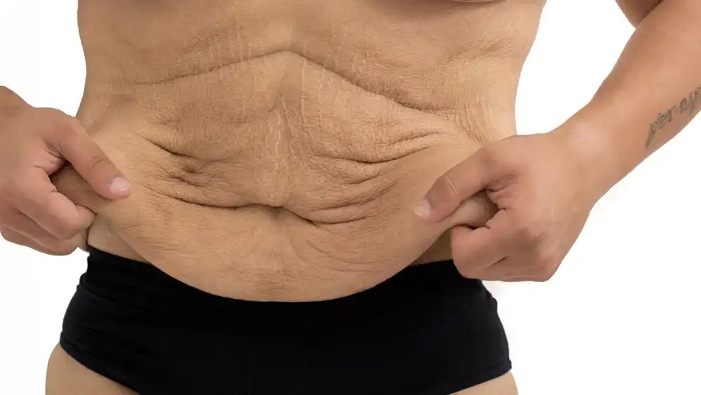 Why Does Weight Loss Medication Leave Some People With Loose or Sagging Skin Brighton and Hove?